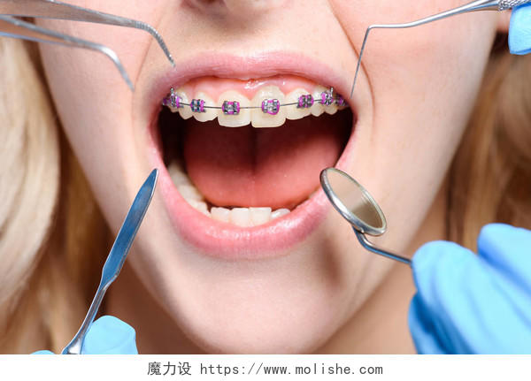 戴着牙套张开嘴的特写牙齿矫正修复口腔牙齿口腔牙齿